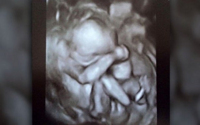 Charlotte baby dabbing like Cam in ultrasound