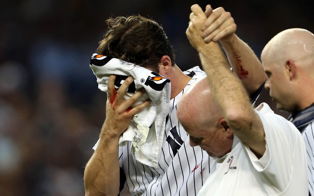 Bryan Mitchell took a line drive to the face on Monday.