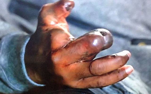 Jason Pierre-Paul shares graphic photos of his fireworks hand injury